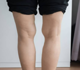Rodillas en valgo – causas y tratamiento de las rodillas en valgo